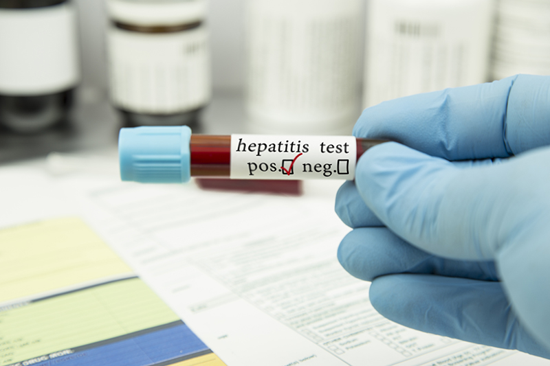 Hepatitis test in the laboratory